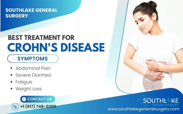 Best Treatment for Crohn's Disease: Expert Options - Southlake General ...